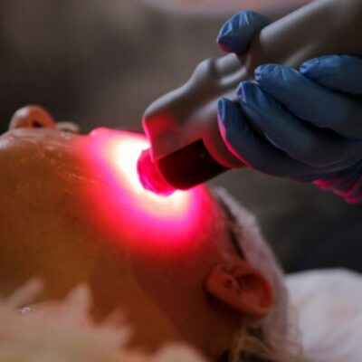 zabieg laseru wolumetrycznego wykonywany w salonie kosmetycznym Allura Olsztyn